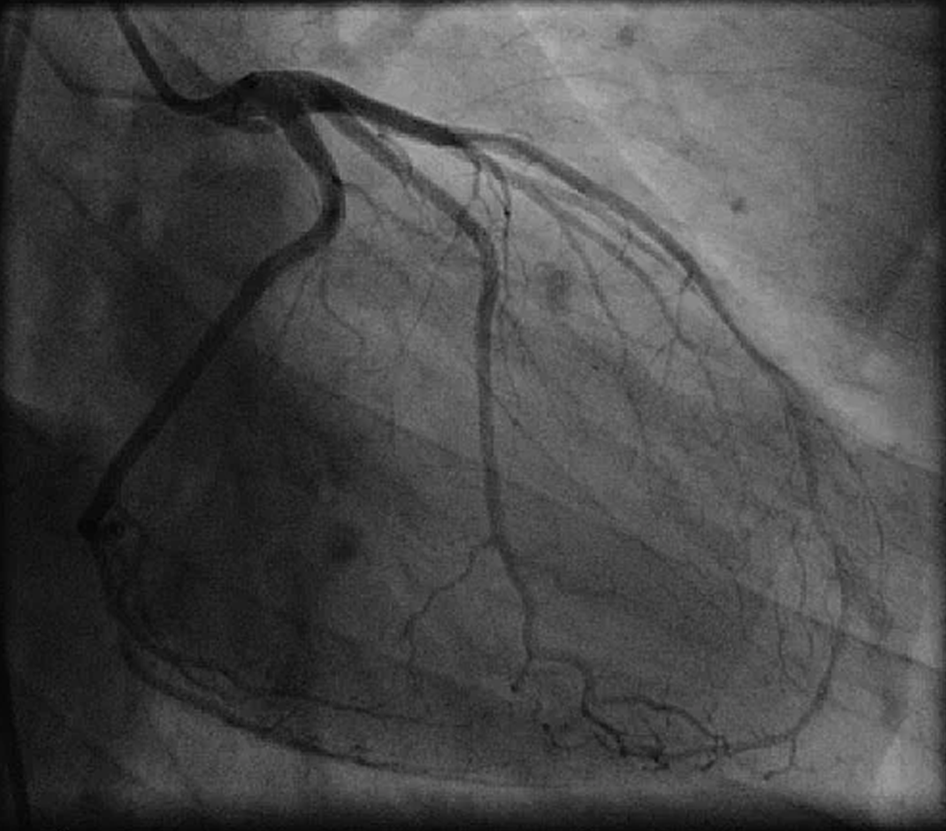 Invisible wires. Coronary Angiography. Angiograms.