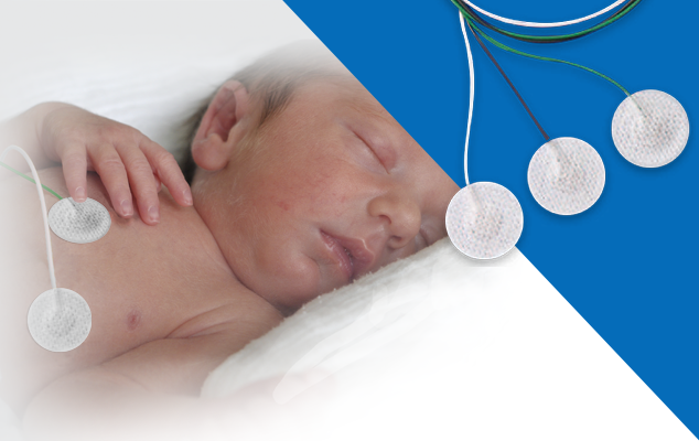 Long-term monitoring electrodes placed on a patient’s torso with lead wires; set of round ECG electrodes shown.