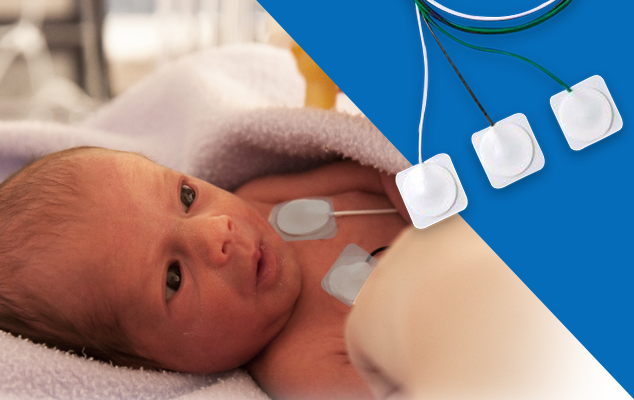 Newborn resting with monitoring electrodes attached; small square neonatal ECG electrodes shown.