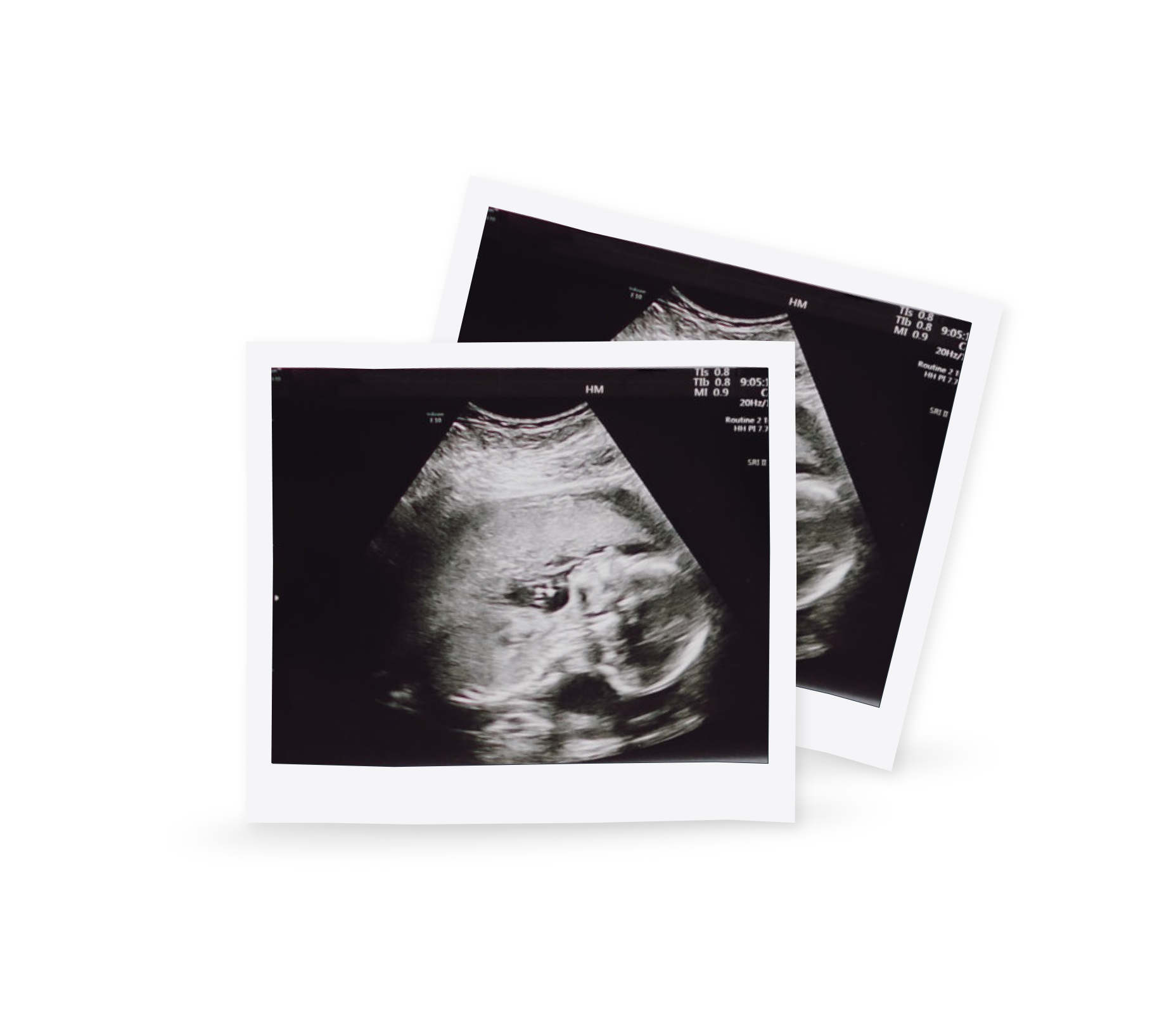 Ultrasound pictures